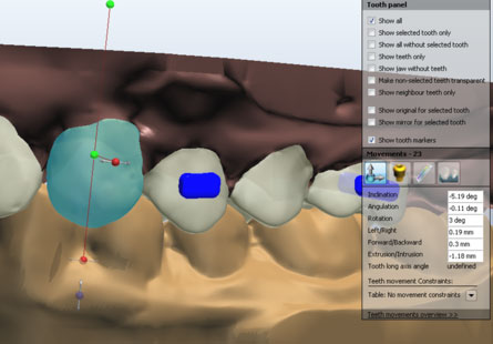 3Dスキャニングで完全オリジナルのマウスピースをご提供